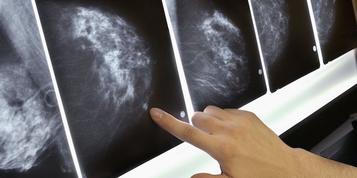 Рак груди – при лишнем весе скрининг должен проводиться чаще