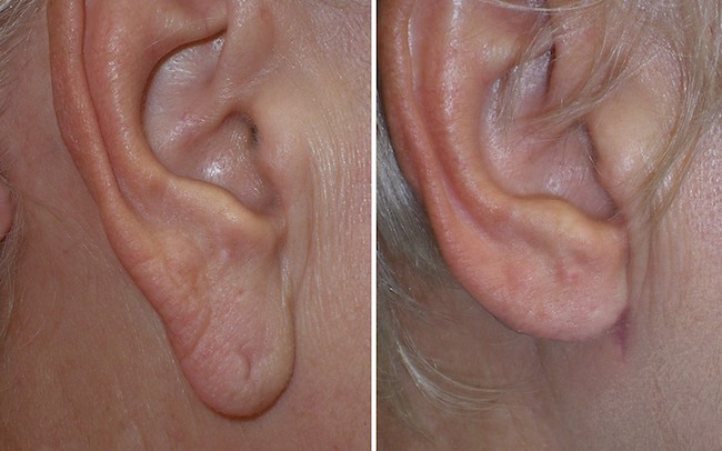 пластика мочки уха