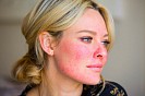 Розацеа кожи лица – причины, симптомы, лечение (фото)